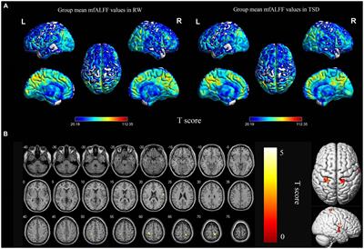 Total sleep deprivation alters spontaneous brain activity in medical staff during routine clinical work: a resting-state functional MR imaging study